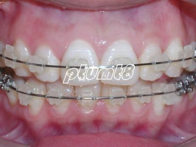 Dental A22 Orthodontics Roth Ceramic Bracket Braces 5 5  